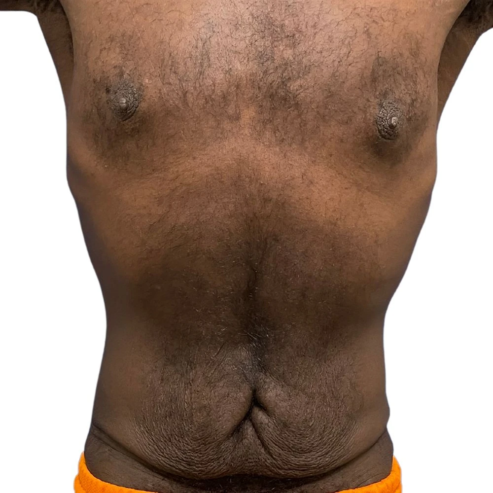 tummy_tuck-7-7b-1
