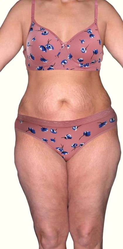 tummy-tuck-21-view-1-detail_2-420x846