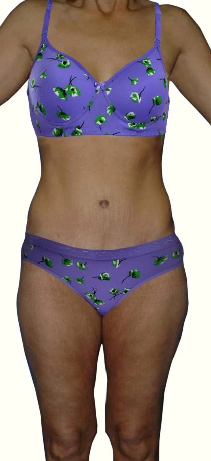 tummy-tuck-21-view-1-detail_3-420x915