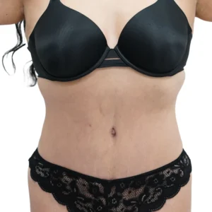 tummy_tuck-13-13b