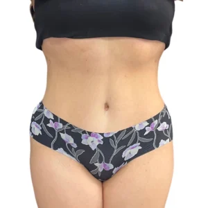 tummy tuck in Los Angeles by Dr. Batal
