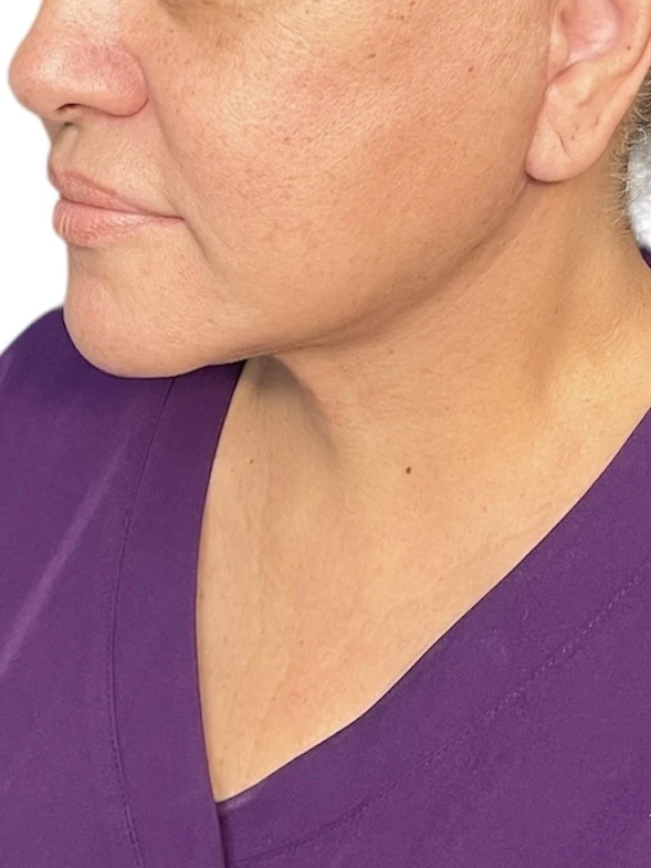 Neck lift 1 month after