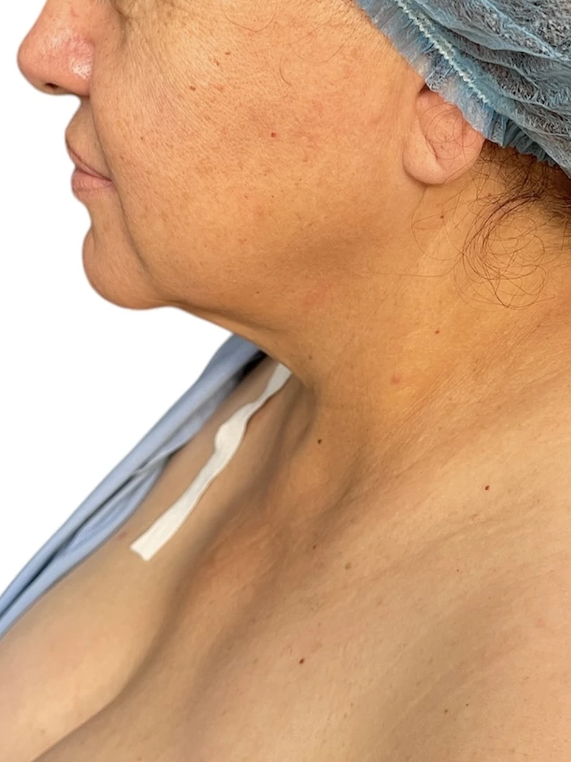Neck lift before