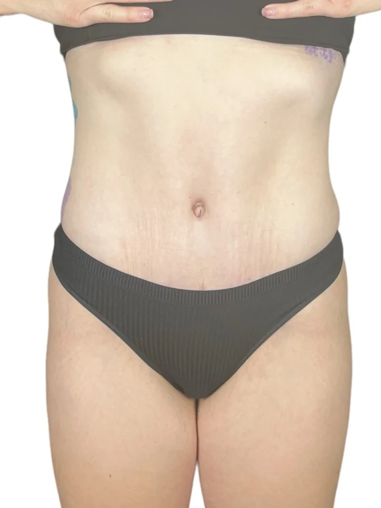 Tummy tuck after 4 months