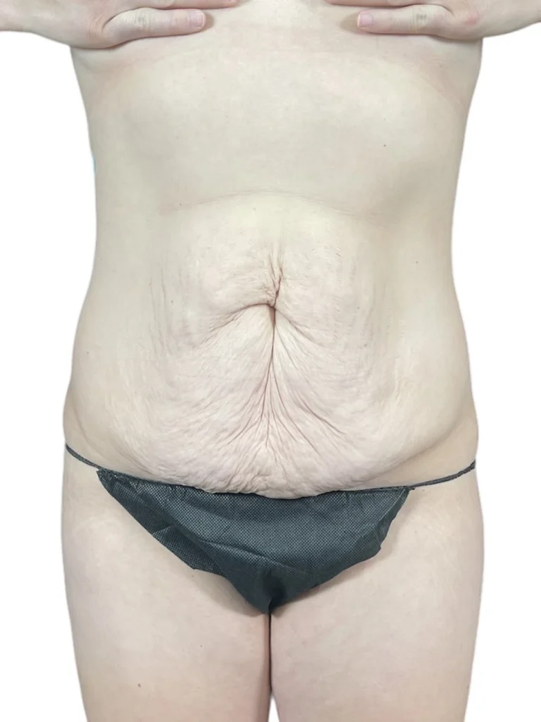 Tummy tuck before