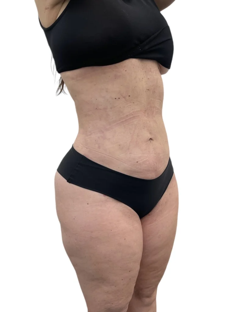 Lipo 360 after