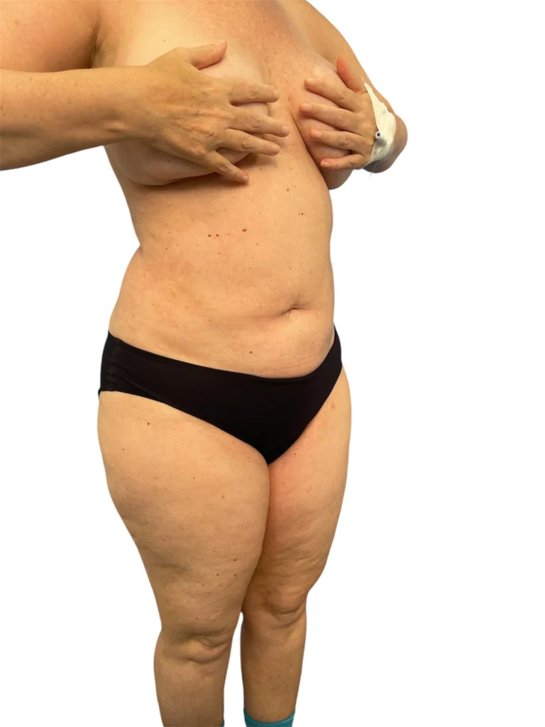 Lipo 360 before